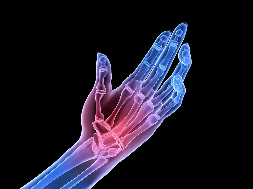2050 yılına kadar yaklaşık bir milyar kişi osteoartrit hastası olacak